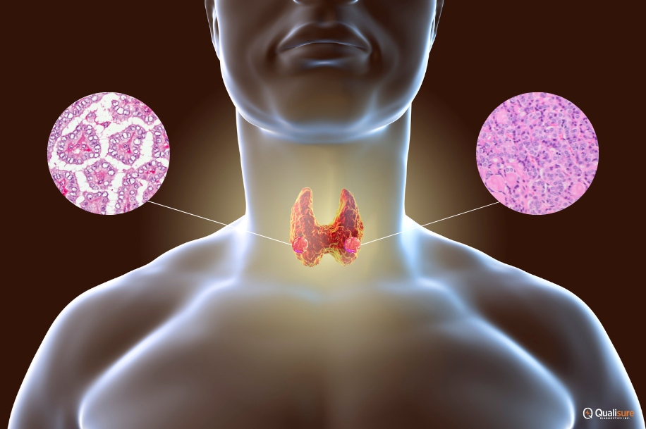 Read more about the article Navigating Thyroid Cancer Treatments: Papillary vs. Follicular Subtypes