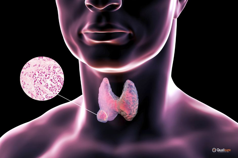 Read more about the article Medullary Thyroid Cancer: Understanding a Unique Thyroid Malignancy