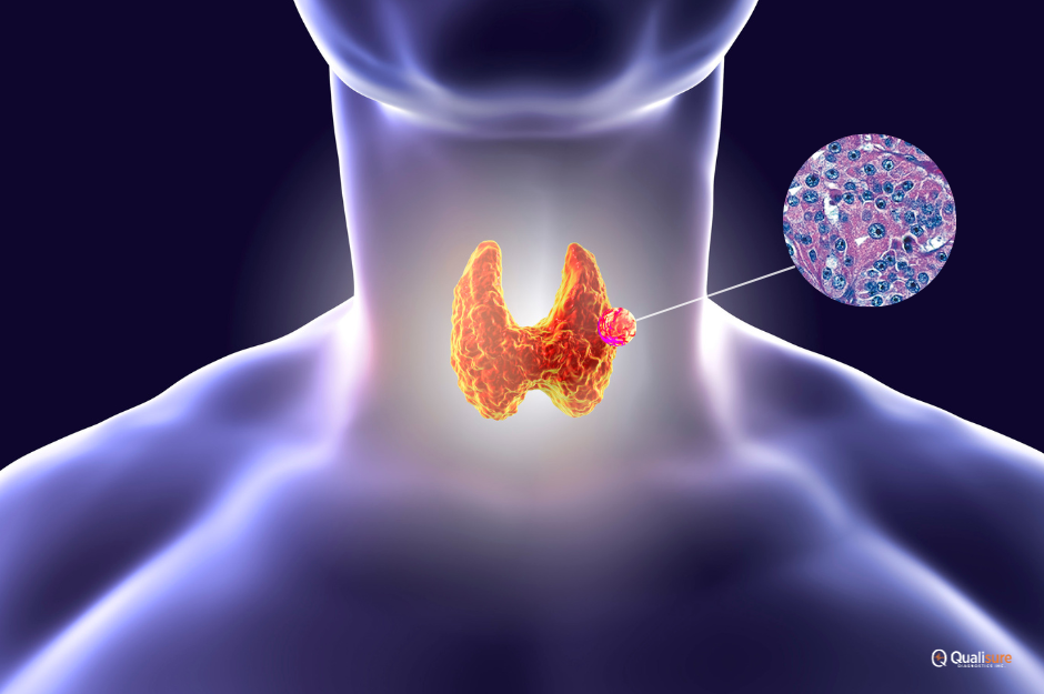 Read more about the article Hürthle Cell Thyroid Cancer: A Rare but Intriguing Subtype