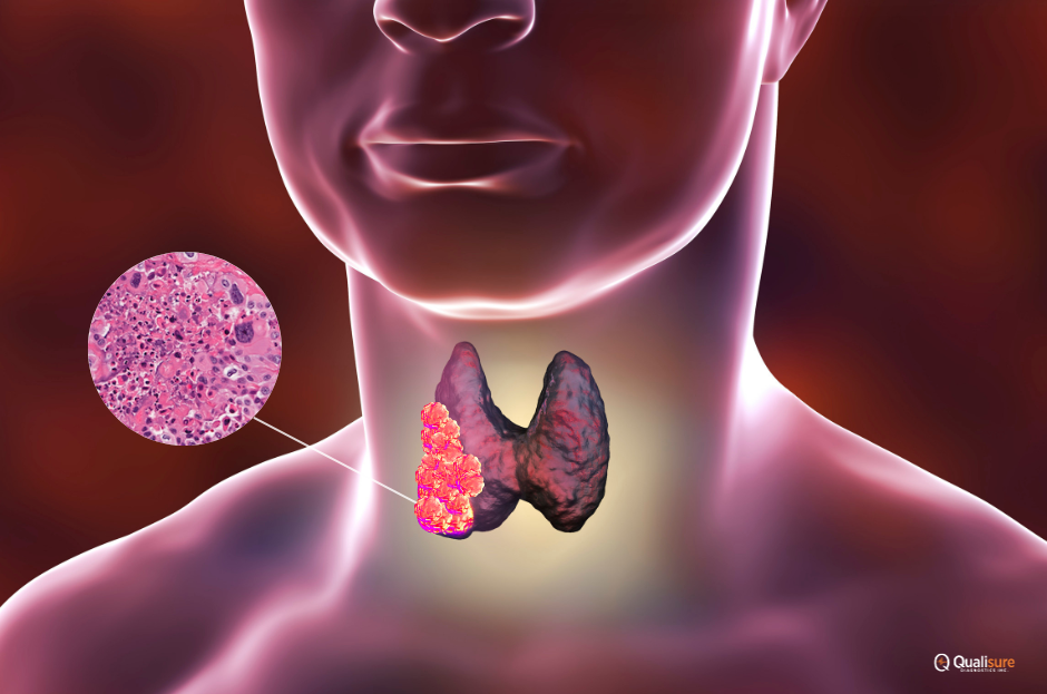 Read more about the article Anaplastic Thyroid Cancer: A Rare but Aggressive Thyroid Malignancy