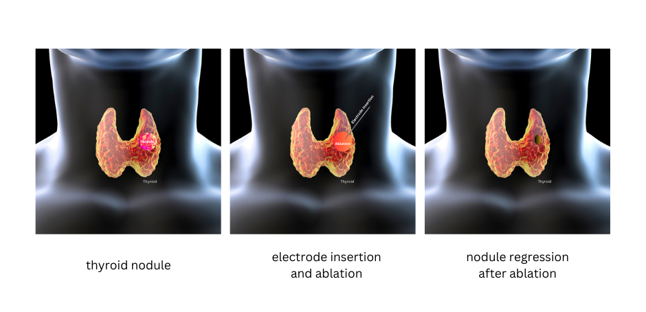 Read more about the article Radiofrequency Ablation: An Alternative Approach to Treating Papillary Thyroid Cancer