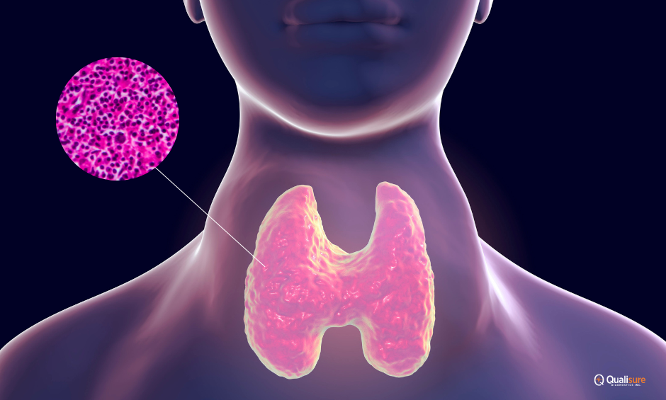 Read more about the article Thyroid Lymphoma: A Rare Form of Immune-Related Thyroid Cancer